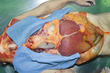 Figure 4-3, Towels placed over the cut margins of the ribs protect against any sharp edges.