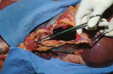 Figure 4-4, The pericardium is opened in the midline from inferior to superior, and the pericardial cavity is inspected. In this case a ruptured myocardial infarct has led to hemopericardium.