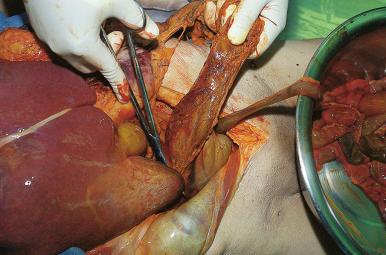 Figure 4-6, The small intestine distal to the ligament of Treitz has been largely removed, the transverse colon is freed, and the posterior attachments of the cecum to the peritoneum are about to be transected. The intestines are collected in a basin before further examination.