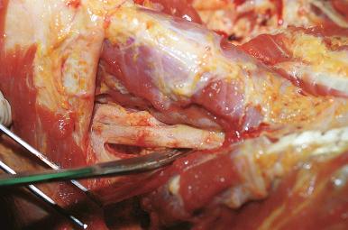 Figure 4-7, The right carotid artery is identified and inspected.