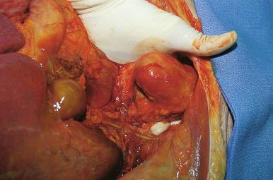 Figure 4-8, Blunt dissection posterior to the rectosigmoid readies the pelvic organs for evisceration.
