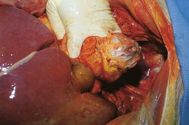 Figure 4-9, The urethra is transected just distal to the prostate, and the cut is continued through the rectum. The pelvic organs are retracted up and out to each side, exposing in turn the right and left iliac vessels, which are then transected just above the femoral canal.