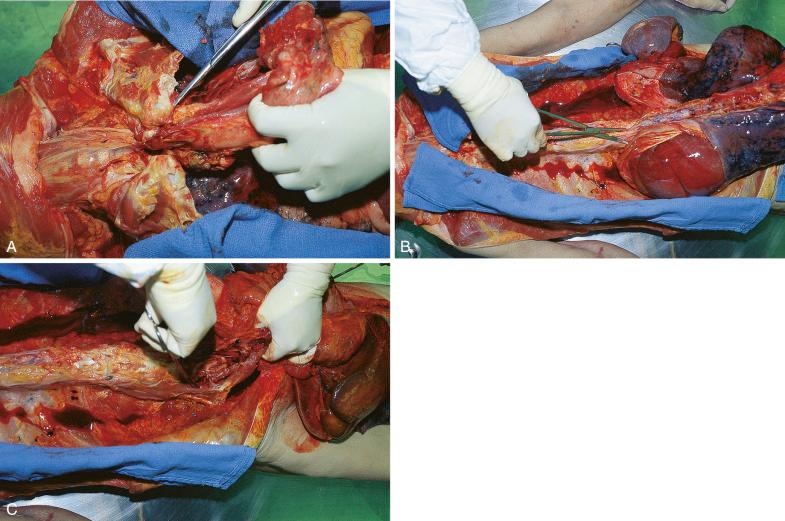 Figure 4-10, The organ block is ready for removal. A, The neck and thoracic organs are lifted anteriorly and then inferiorly, and the aorta and other posterior attachments are separated from the vertebral column. B, The evisceration is continued by applying anterior and inferior traction, cutting as needed any remaining diaphragmatic or posterior abdominal wall attachments. C, Finally, any posterior attachments in the pelvis are severed to free the entire organ block.