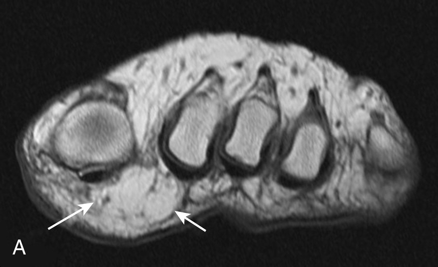 Fig. 1.16, Frequency-selective fat saturation.