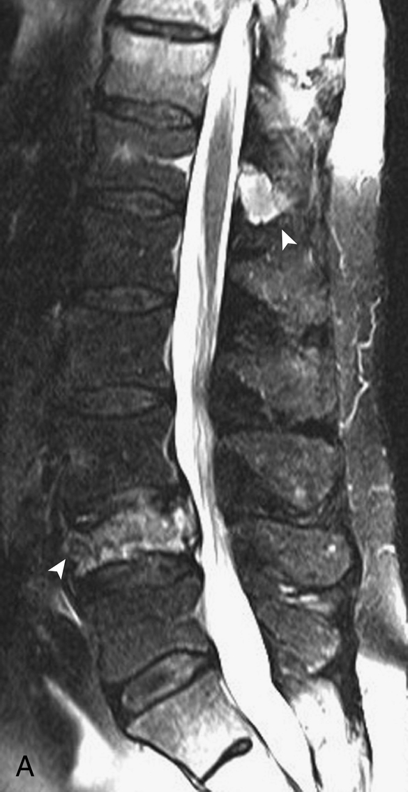 Fig. 1.18, Pitfall: heterogeneous fat saturation.