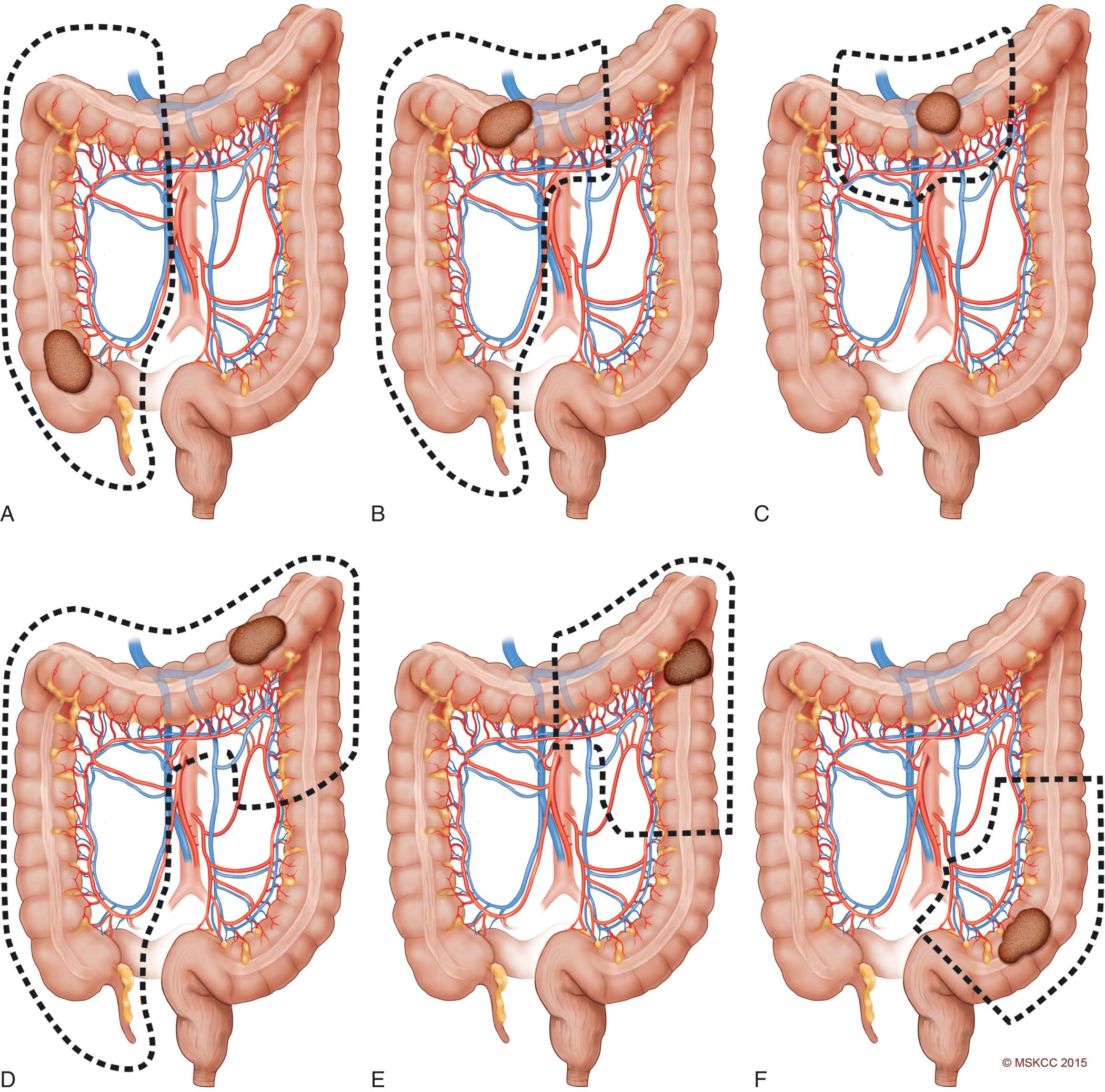 FIGURE 166.2, Segmental colonic resection. (A) Right colectomy; (B) right colectomy extended to transverse colon; (C) transversectomy; (D) right colectomy extended to the splenic flexure; (E) left colectomy; (F) sigmoidectomy.