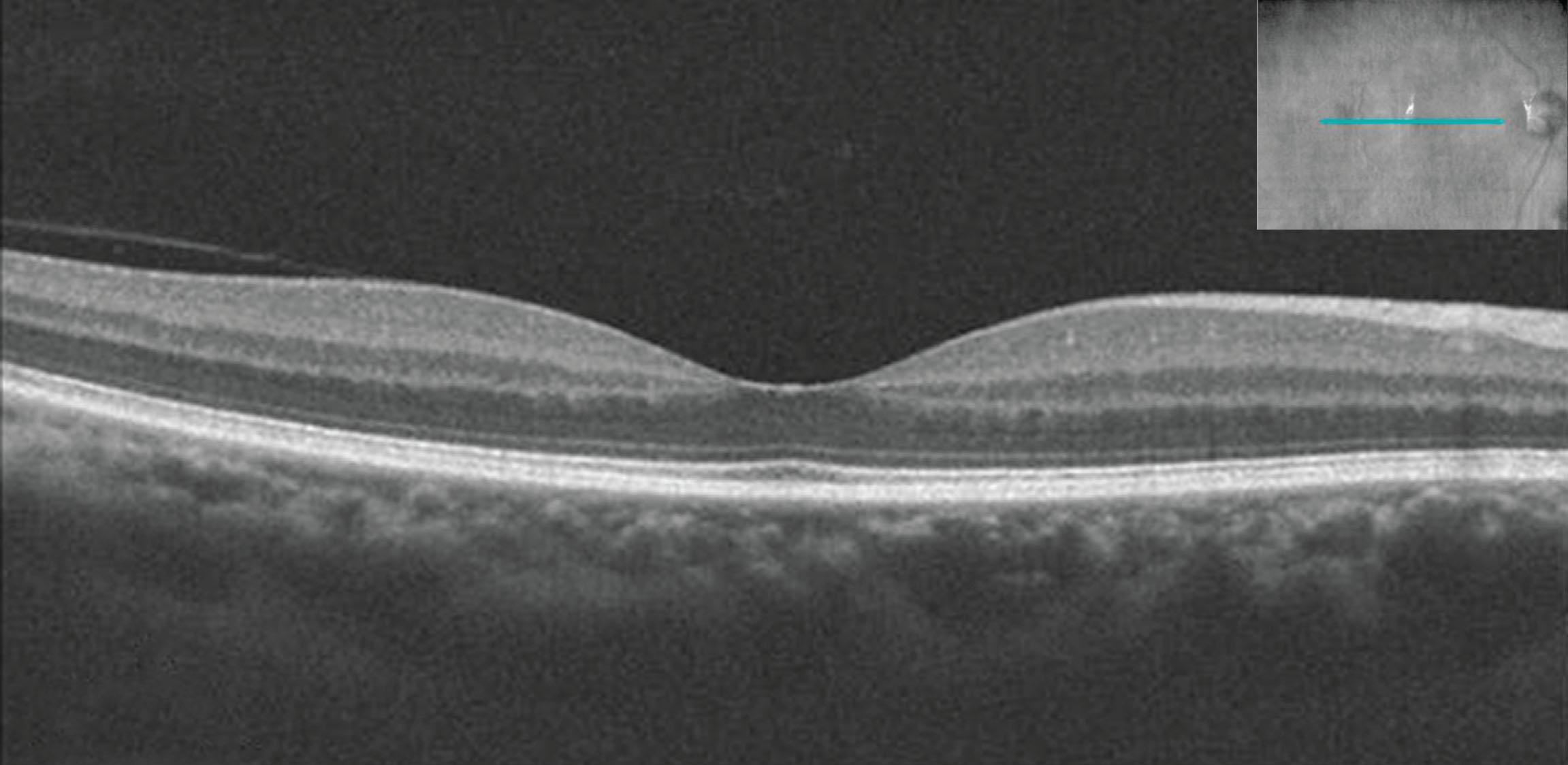 Figure 1.2.1, Line scan through the macula. Inset depicts an en face image of the summoned voxel projection with a cyan line indicating the location of the line scan.