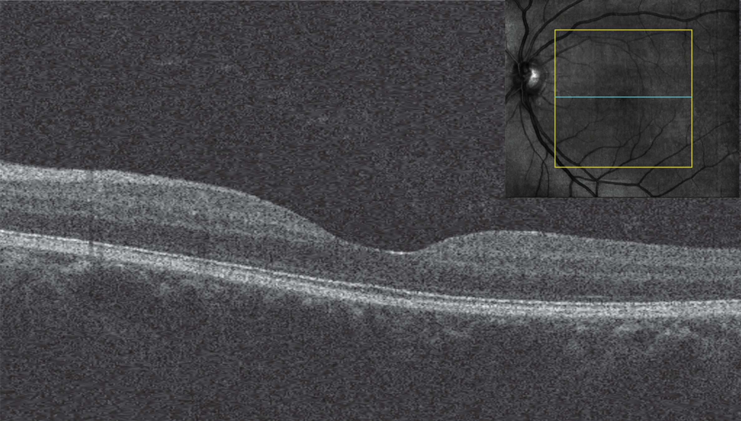 Figure 1.2.2, Single B-scan from a macular cube, with the inset depicting the location of the B-scan. Note the lower resolution of the B-scan in comparison with the line scan in Figure 1.2.1 .