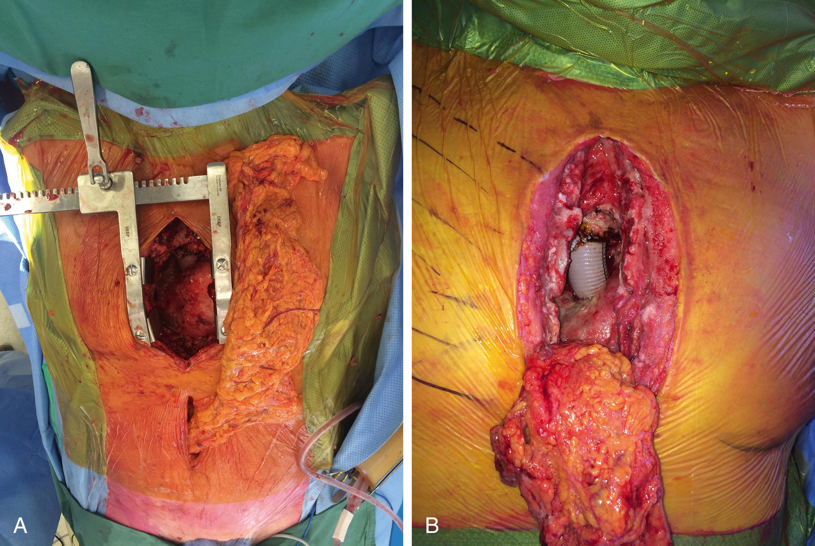 Fig. 2.1, Omental flap used for salvage of an infected aortic Dacron graft. (A) Omental flap raised and laid out before being tunneled into the thorax. Showing the reach of the omental flap. (B) Omental flap tunneled and wrapped around the infected Dacron aortic graft on the ascending aortic arch.