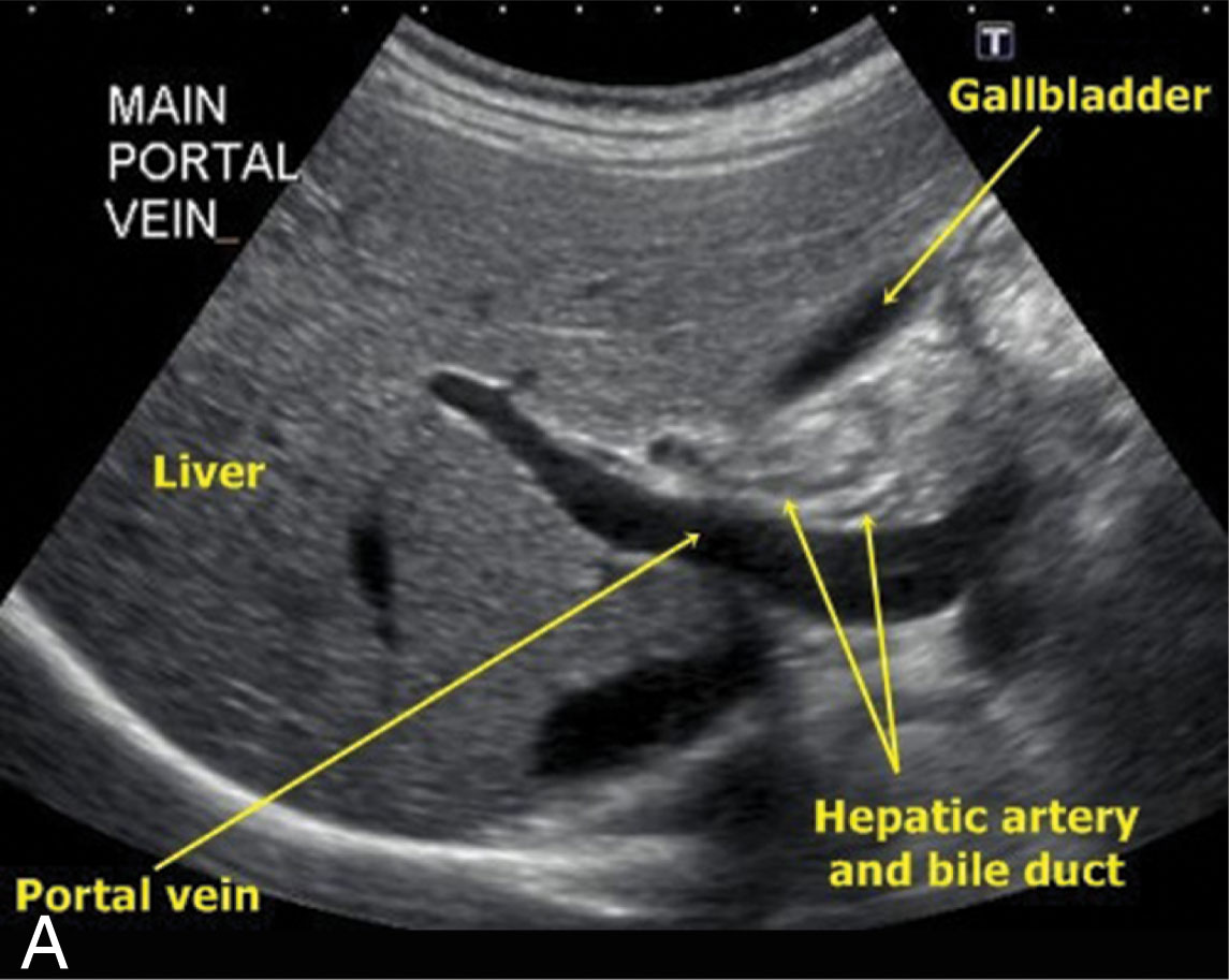 Fig 6.3, Images of the abdomen and pelvis demonstrating the difference between the curved array (A and C) and the sector array (B); note the great near field definition and larger field of view with the curved array transducer (D).