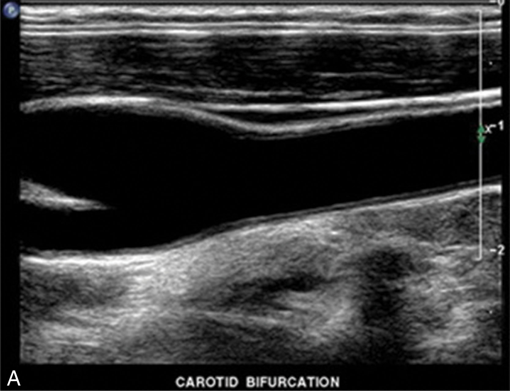 Fig 6.4, Images of the carotid artery bifurcation (A) and the shoulder muscles (B) are well demonstrated with the linear array transducer. Note the detail in the near field with the higher frequency transducer.