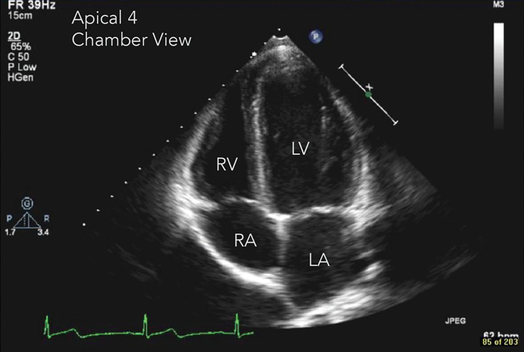 Fig 6.5, The sector phased array is utilized in echocardiography.