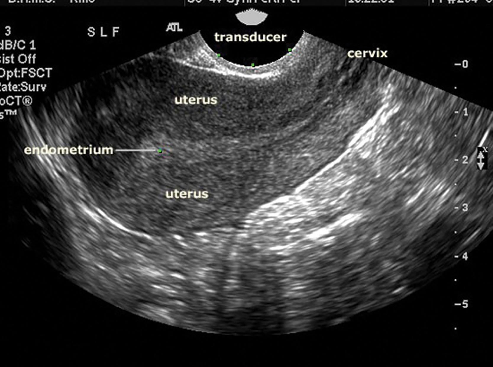 Fig 6.6, The transvaginal probe uses a high frequency to provide excellent detail of the pelvic structures.