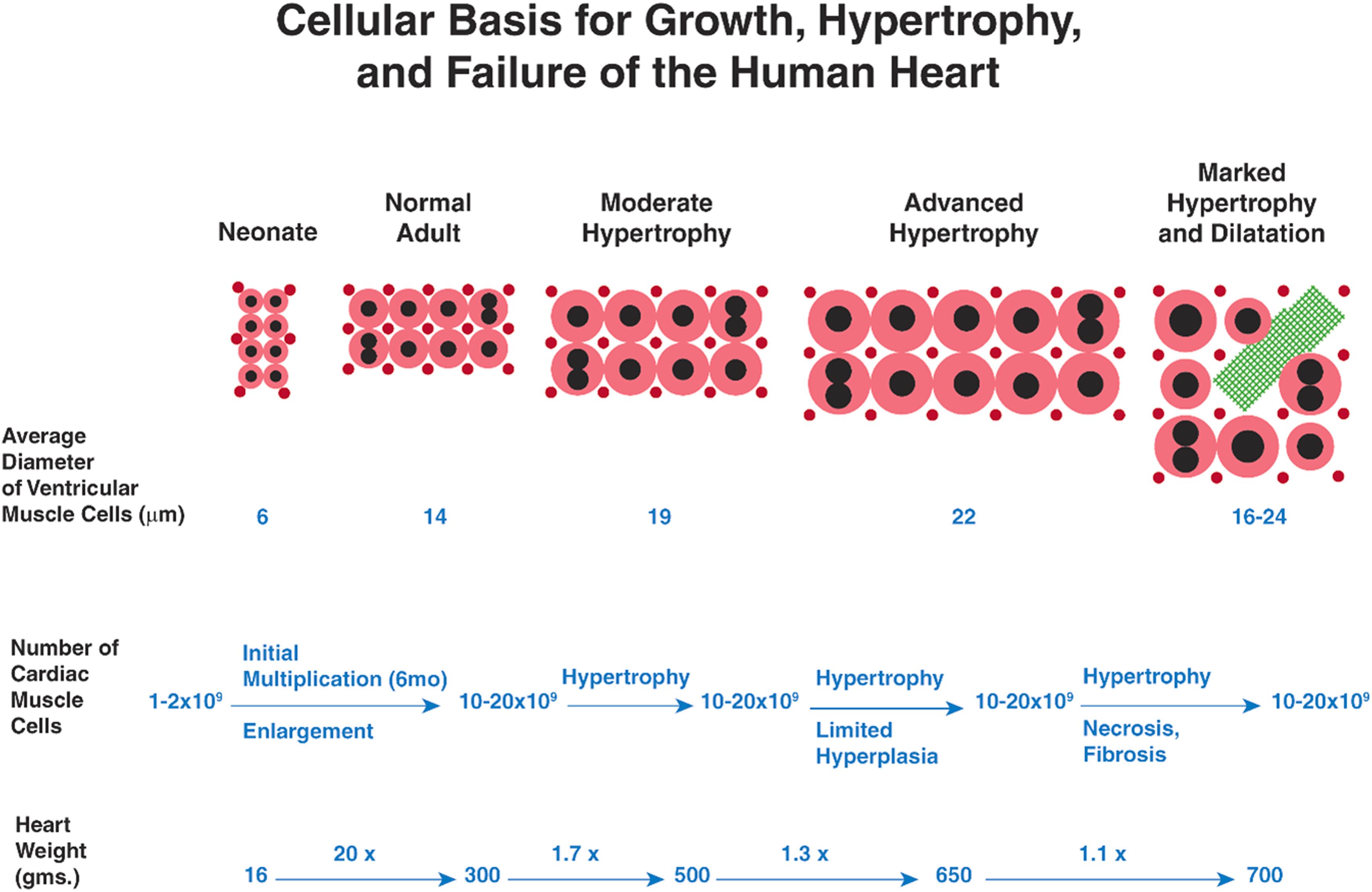 Figure 21.3, Cellular basis for growth, hypertrophy, and failure of the human heart. Cellular basis for growth, hypertrophy, and failure of the human heart. This figure depicts various stages in the growth of the myocardium and the myocardial response to chronic stress, based on morphometric data. After an initial phase of simultaneous multiplication and enlargement of cardiomyocytes in the fetus and in the first few months of neonatal life, subsequent development of the adult heart occurs by enlargement of existing cardiomyocytes coupled with proliferation of the capillary network. The one-to-one ratio of cardiomyocytes to capillaries is maintained thereafter. In response to stress, the heart mass increases by hypertrophic enlargement of existing cardiomyocytes associated with polyploidy of nuclear DNA and formation of increased numbers of binucleated cardiomyocytes. Once a critical heart weight of 500 g (200 g left ventricular weight) is exceeded, there is continued hypertrophy of existing myocytes plus apparent formation of new myocytes (hyperplasia), based on morphometric analysis. Further hypertrophy exceeds coronary vascular reserve with subsequent cardiomyocyte necrosis, rearrangement of cardiomyocytes, fibrosis, and structural dilation of the chambers of the decompensated, failing heart.
