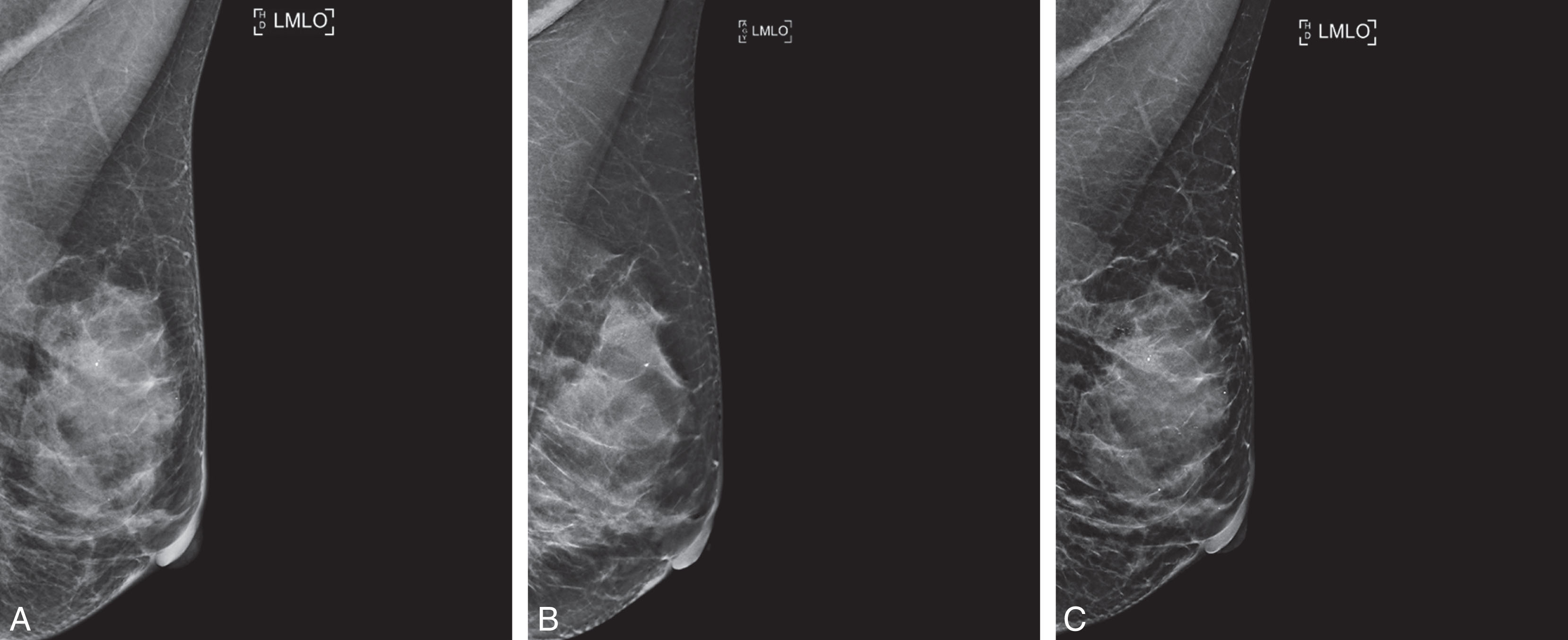 Basics Of Digital Breast Tomosynthesis Clinical Tree 7233