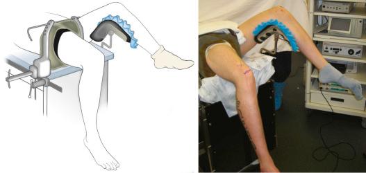Fig. 92.1, The patient is positioned supine with use of a leg holder on the lateral post.