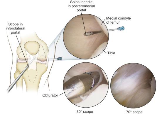 Fig. 92.5, View of the intercondylar notch from the posteromedial portal.