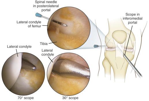 Fig. 92.6, View of the intercondylar notch from the posterolateral portal.