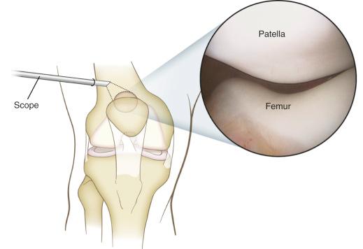 Fig. 92.7, Visualization of the patellofemoral joint.