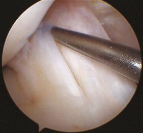 Fig. 92.8, Arthroscopic appearance of the two bundles of the anterior cruciate ligament.