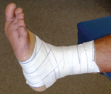 Fig. 33.2, Closed basket weave ankle taping technique.