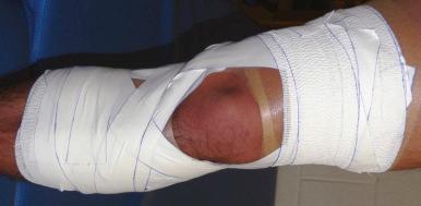 Fig. 33.5, Knee stability taping technique.