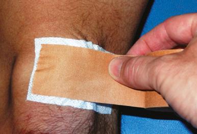 Fig. 33.6, McConnell medial patellar glide taping technique.