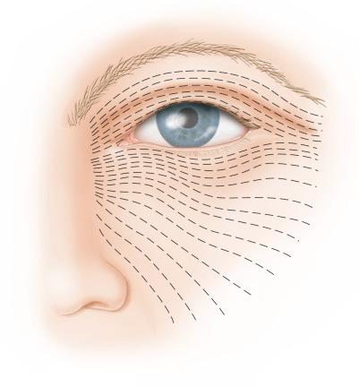 Diag. 2.1, Relaxed skin tension lines around the eye.