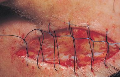 Fig. 2.2a, Interlocking suture before tightening.