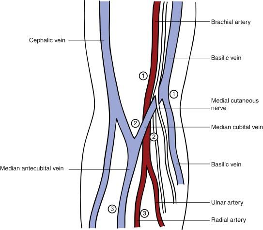 Figure 65-1, The most common sites for anastomosing the basilic vein to the brachial artery. ( 1 ) The basilic vein is divided at the entry of the median cubital into the basilic vein and transposed to the brachial artery in one stage. ( 2 ) The basilic vein is divided in the antecubital fossa and anastomosed to the distal brachial artery. This may be part of either a one- or a two-stage transposition procedure. ( 3 ) A side-to-side anastomosis is created between the median antecubital, cephalic, or median cubital vein and the proximal radial artery. No second stage may be necessary if retrograde venous valve destruction results in maturation of forearm veins. If it does not, a second-stage cephalic or basilic vein transposition is needed.