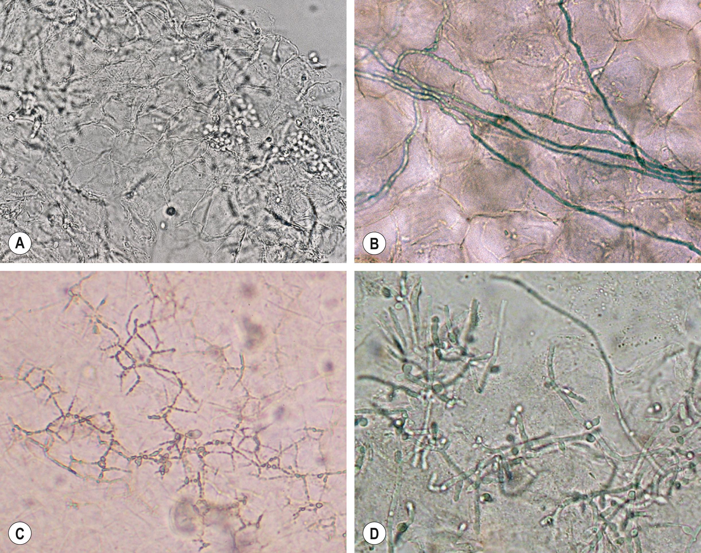 Fig. 2.1, Microscopic examination of potassium hydroxide (KOH) preparations of scale.