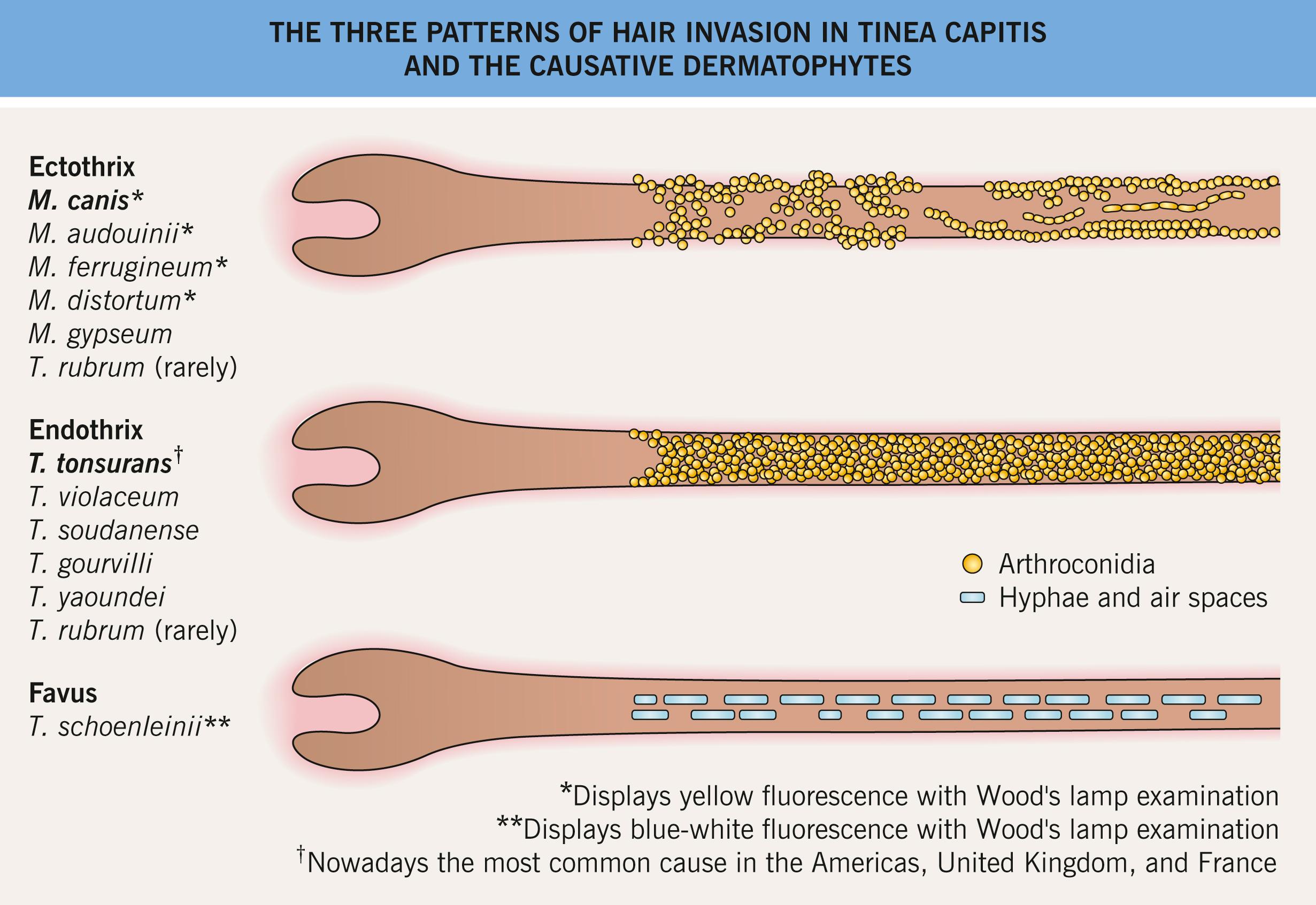 Fig. 2.2, The three patterns of hair invasion in tinea capitis and the causative dermatophytes.