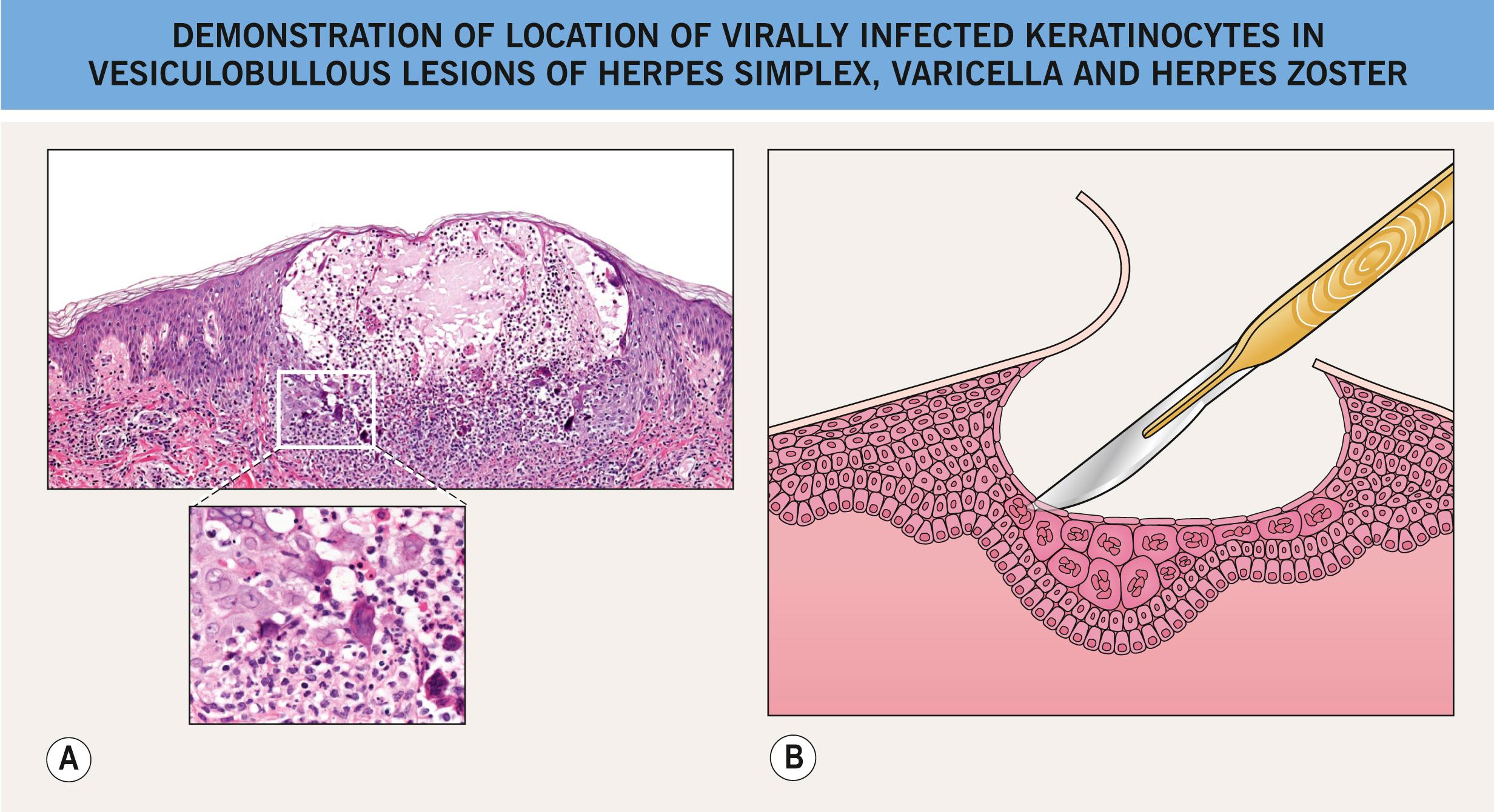 Fig. 2.6, Demonstration of location of virally infected keratinocytes in vesiculobullous lesions of herpes simplex, varicella, and herpes zoster.