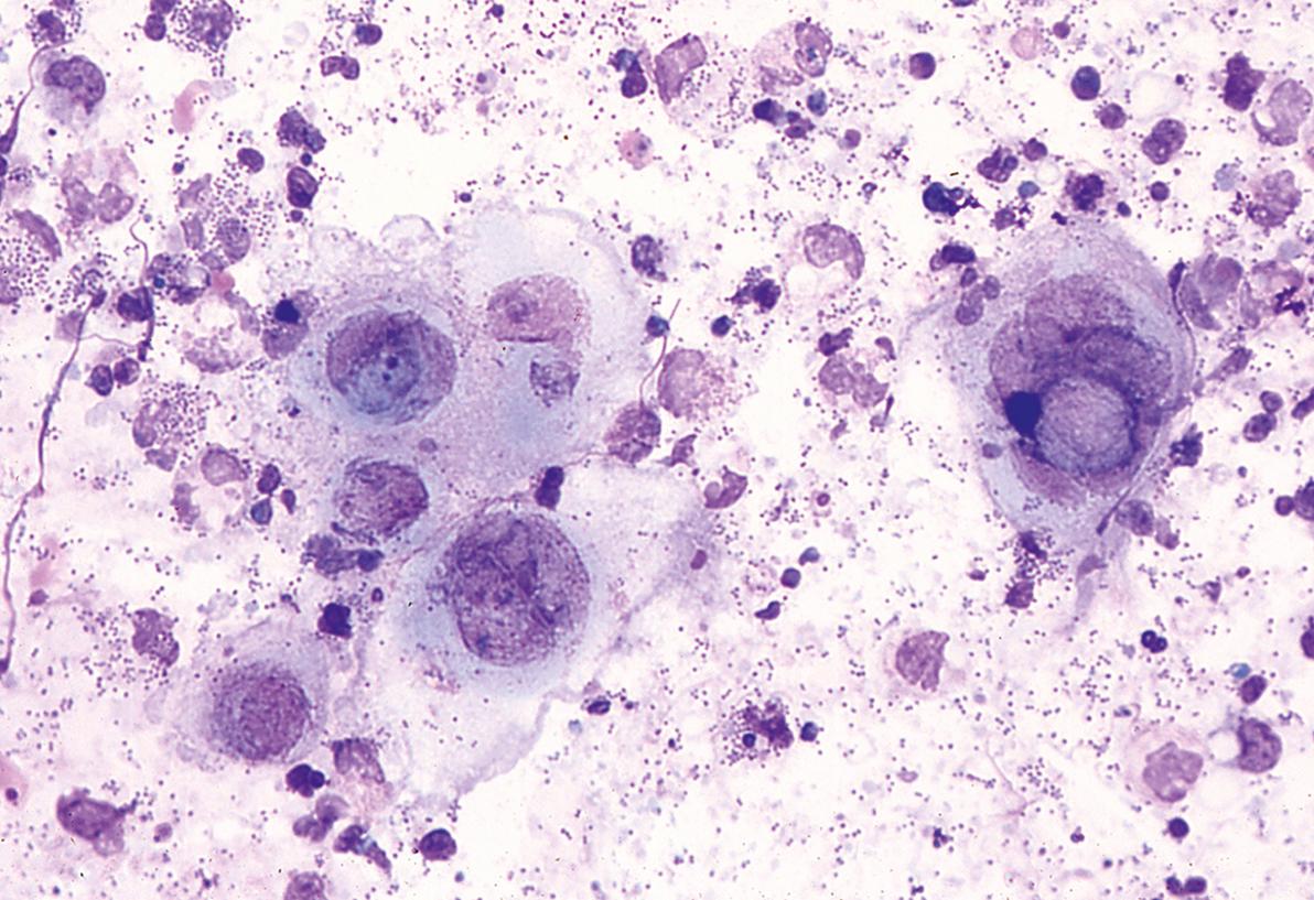 Fig. 2.7, Tzanck smear demonstrating multinucleated giant cells.