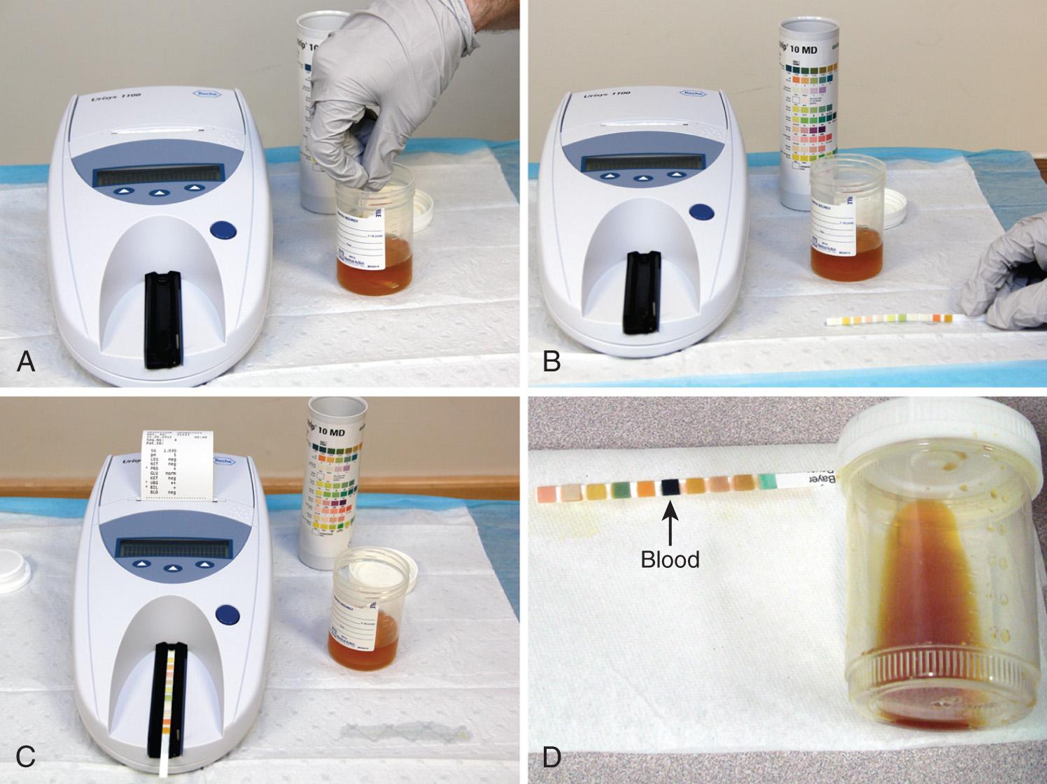 Figure 67.2, Urine dipstick testing. A, Totally immerse the dipstick in urine for a few seconds. B, Place it on its side on a paper towel to allow drainage of urine and limit cross-contamination of the individual testing squares. Note that the bottle of test strips should be closed immediately because prolonged exposure to air can produce false results. C, Formal reading of the test strip is accomplished electronically rather than only by the naked eye for quality assurance and a permanent record. D, Myoglobinuria: strongly positive for blood on the dipstick with no red blood cells on microscopy.