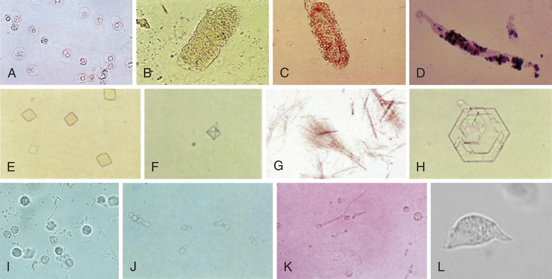 Figure 67.3, Microscopic urinanalysis. A, Neutrophils. B, Fine granular cast. C, Red blood cell cast (the distinct and uniformly spherical shape of the erythrocyte is visible). D, White blood cell cast (seen with intrinsic renal diseases such as pyelonephritis and glomerulonephritis; note the discernible nuclei and cell boundaries). E, Uric acid crystals. F, Calcium oxalate crystals. G, Calcium phosphate crystals. H, Cysteine crystal (indicative of cystinuria). I, Bacteria and leukocytes. J, Candida , budding yeast. K, Candida , pseudohyphae. L, Trichomonas vaginalis .