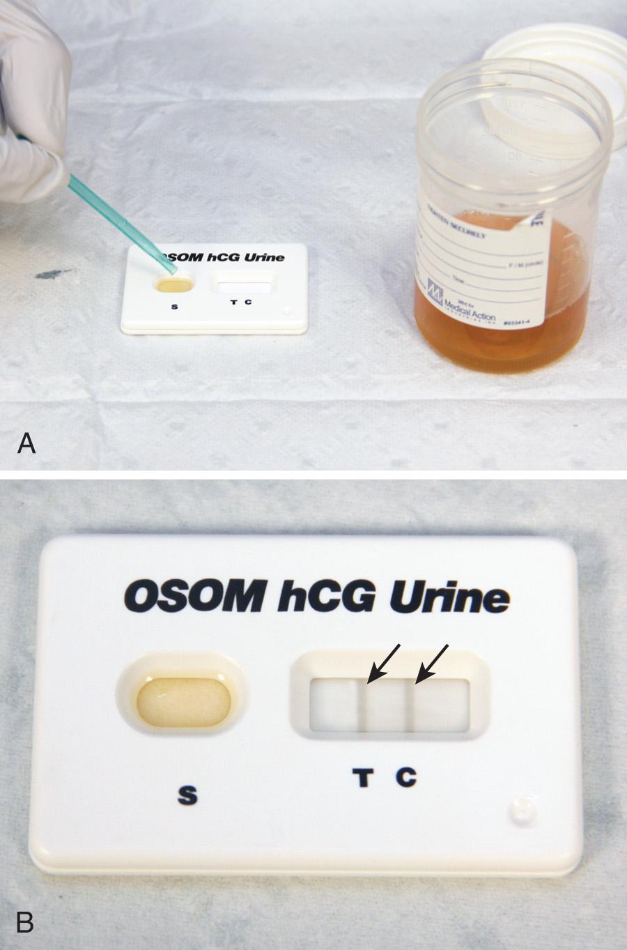 Figure 67.4, Urine β-human chorionic gonadotropin (β-hCG) testing. A, The concentration of β-hCG is usually lower in urine than in serum, thus making the urine test slightly less sensitive for the detection of early pregnancy. Whole blood specimens can also be used in these kits (see text). B, This test is positive, as indicated by the dark stripe in both the test (T) and control (C) positions (arrows).