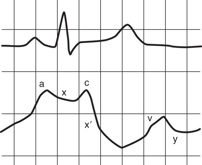 Fig. 12.1, Atrial pressure tracing. See text for label descriptions.