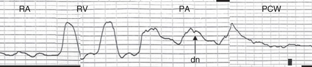 Fig. 12.2, Pressure tracings as the catheter is advanced through the right-sided chambers. As the catheter moves from the right atrium (RA) to the right ventricle (RV) , a ventricular wave form is seen representing isovolumic contraction, ejection, and diastole. When the catheter passes into the pulmonary artery (PA) , the diastolic pressure rises. The dicrotic notch (dn) is produced by the closure of the pulmonic valve. If the catheter is advanced farther, it attains the wedge position. PCW, Pulmonary capillary wedge.