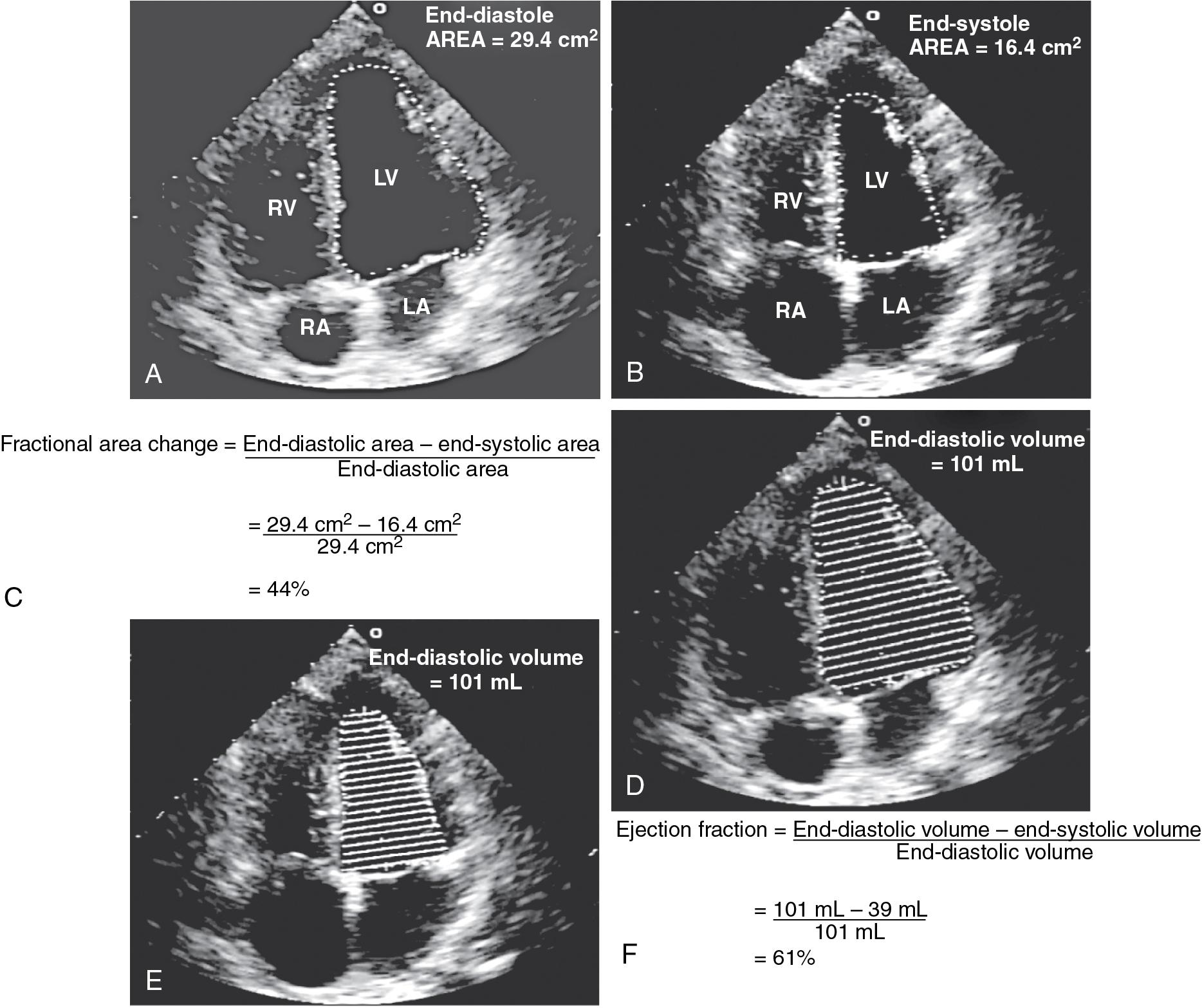 Fig. E2.1, Fractional area change and ejection fraction calculation.