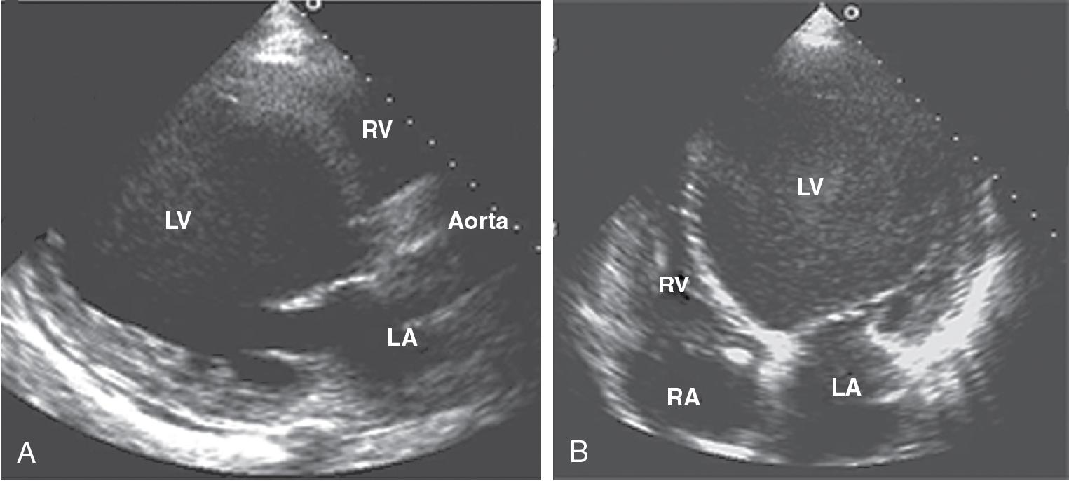 Fig. E2.3, Dilated cardiomyopathy.