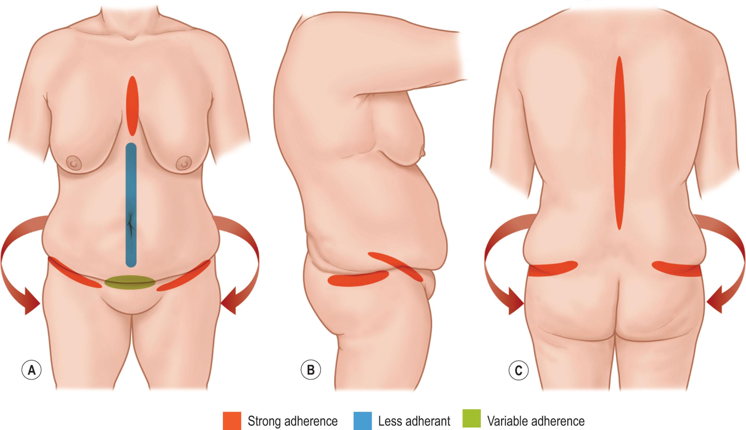 Figure 31.1, The zones of adherence of the trunk. Note the inferomedial descent of tissues that occurs with aging and/or weight loss.