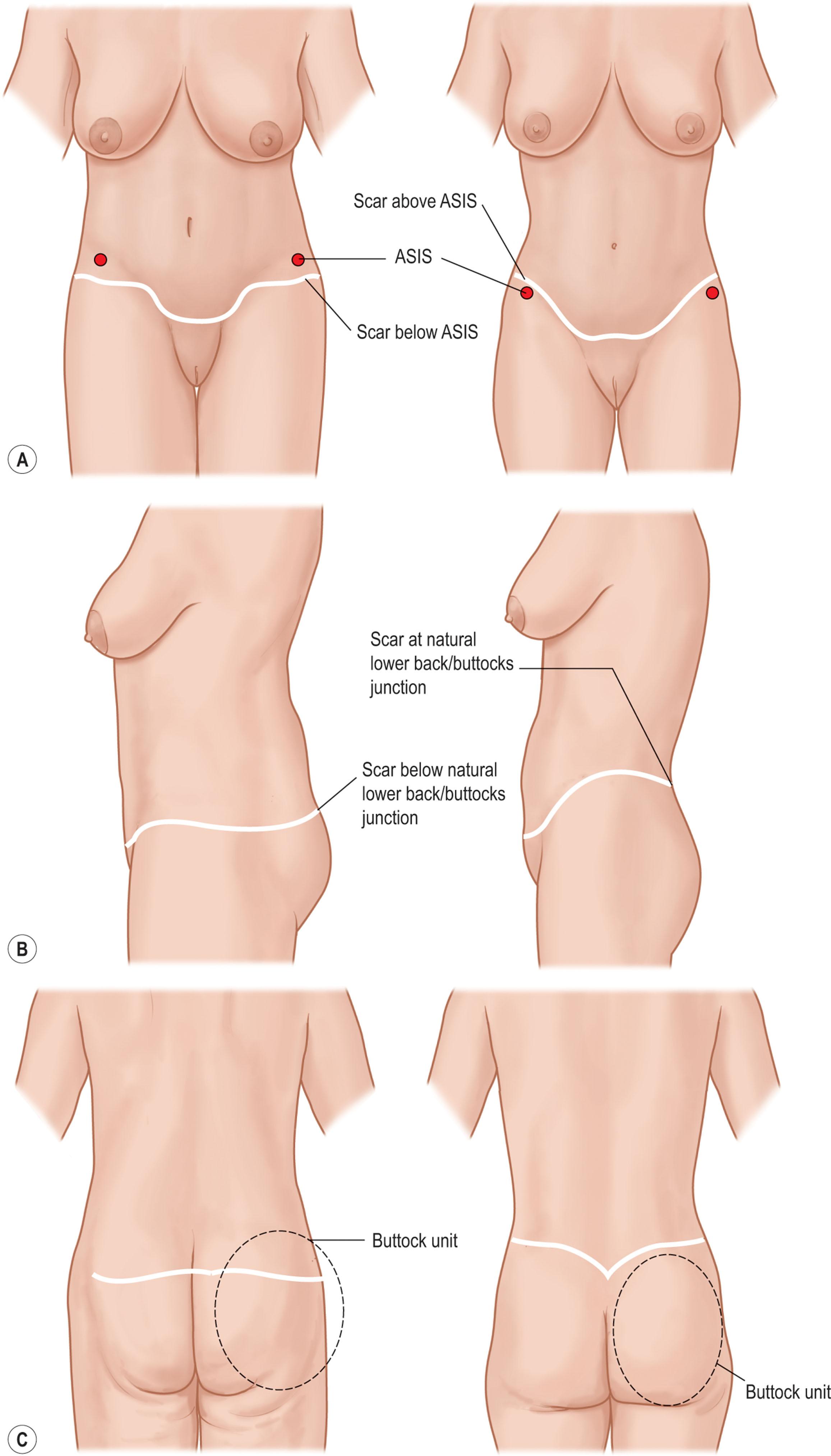 Figure 31.12, Overall, the scar in a lower bodylift type II is more inferiorly placed than in a belt lipectomy. Anteriorly, the final scar is below the anterior superior iliac spine in a lower bodylift type II (A, left) , and above it in a belt lipectomy (A, right) . Laterally and posteriorly, the scar is below the natural junction of the lower back with the buttocks (B,C left) , whereas it is located at, or just above, the natural junction in a belt lipectomy (B,C right) .