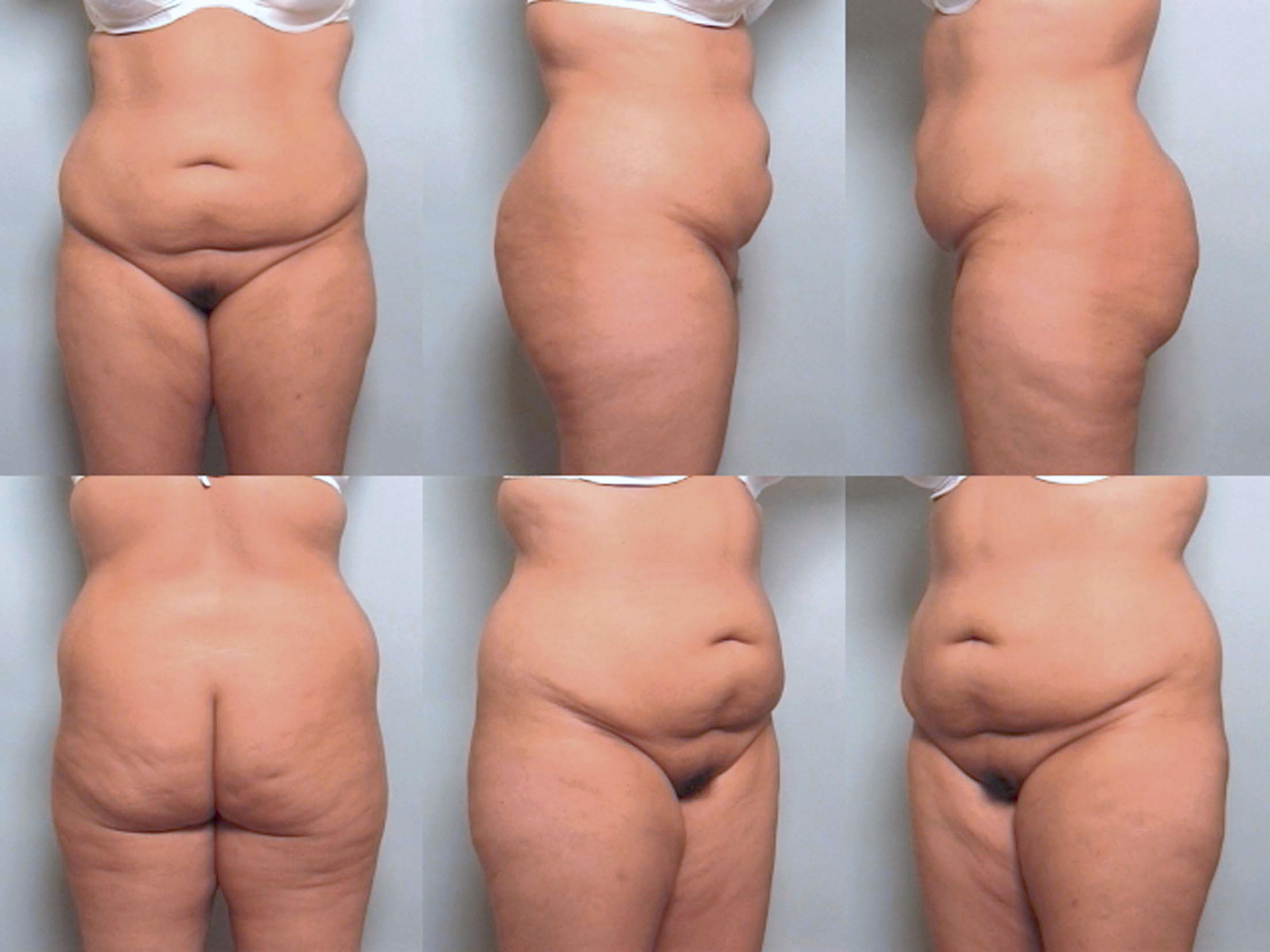 Figure 31.3, This patient is typical of the “20–30 pounds overweight” group. Note the generalized circumferential lipodystrophy of the lower trunk.