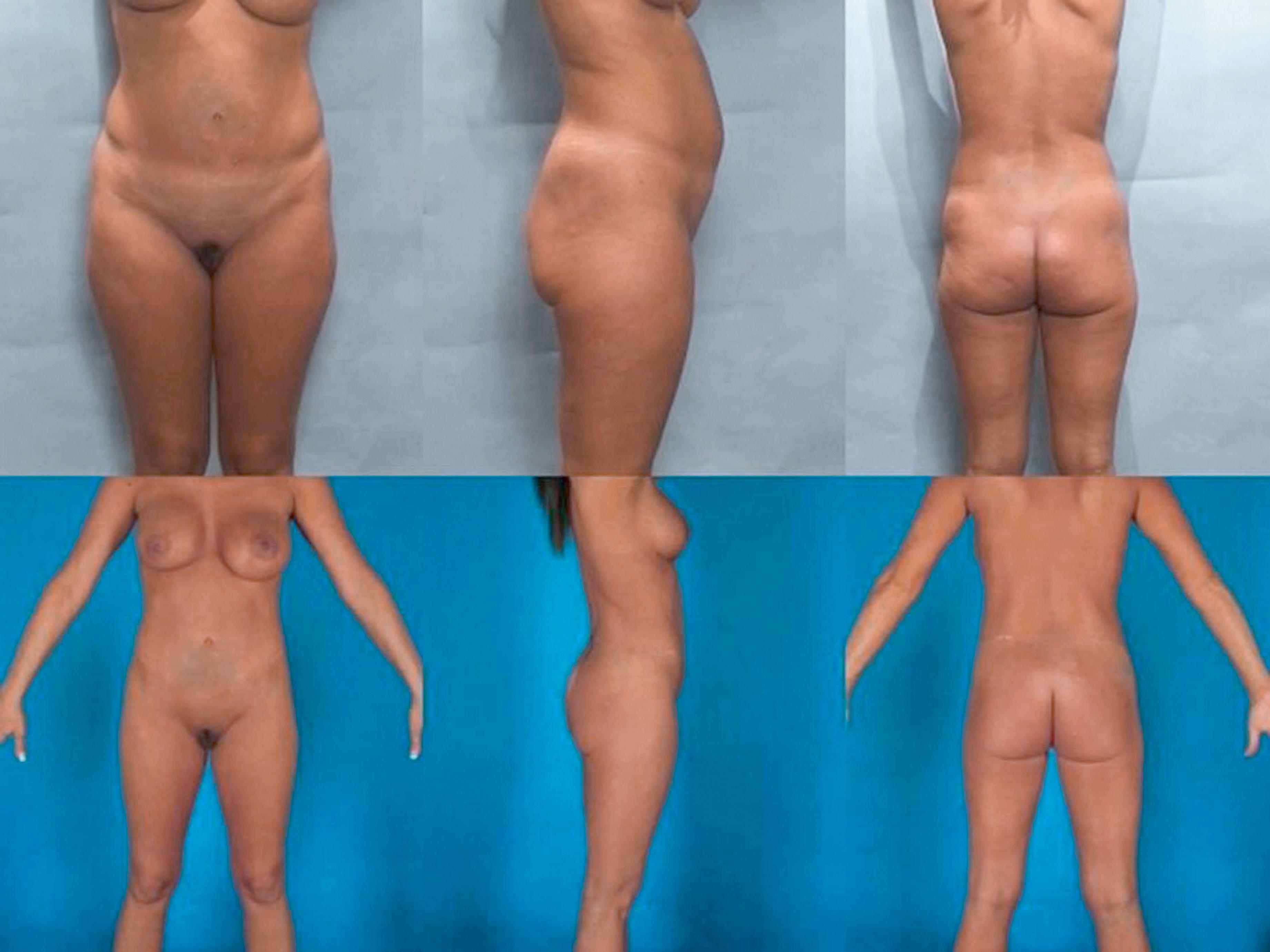 Figure 31.4, This patient presented in her mid-30s with a desire to improve her abdominal contour but also desired the best possible contour of her entire lower trunk, which included better waist definition, lifting of her anterior and lateral thighs, as well as a buttocks lift.