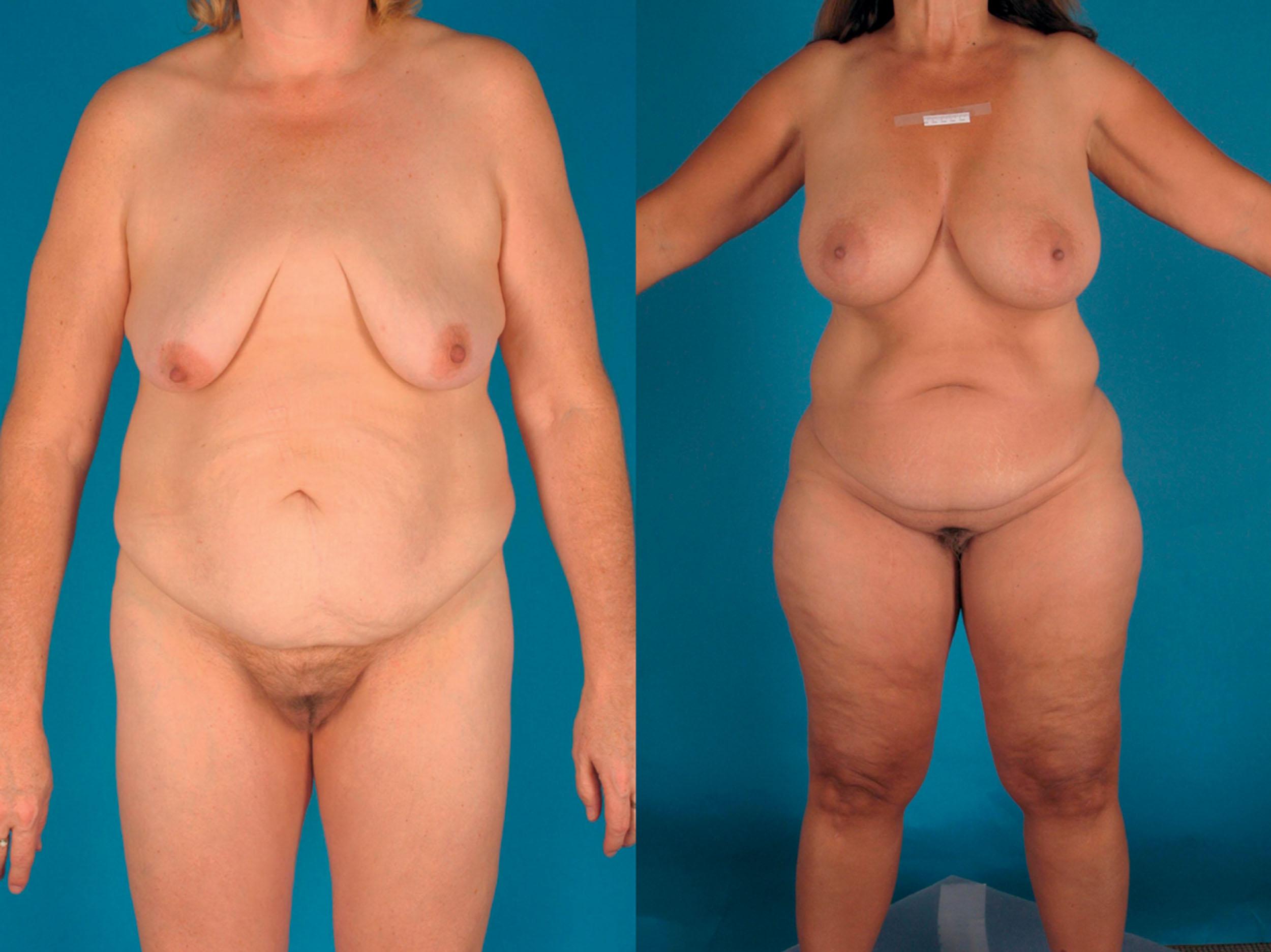 Figure 31.7, Two patients demonstrating the two most common fat deposition patterns. On the left, the “apple” shape is shown, most often encountered in males, although demonstrated in a female here. On the right, the typical “pear”-shaped female pattern of fat deposition is shown.