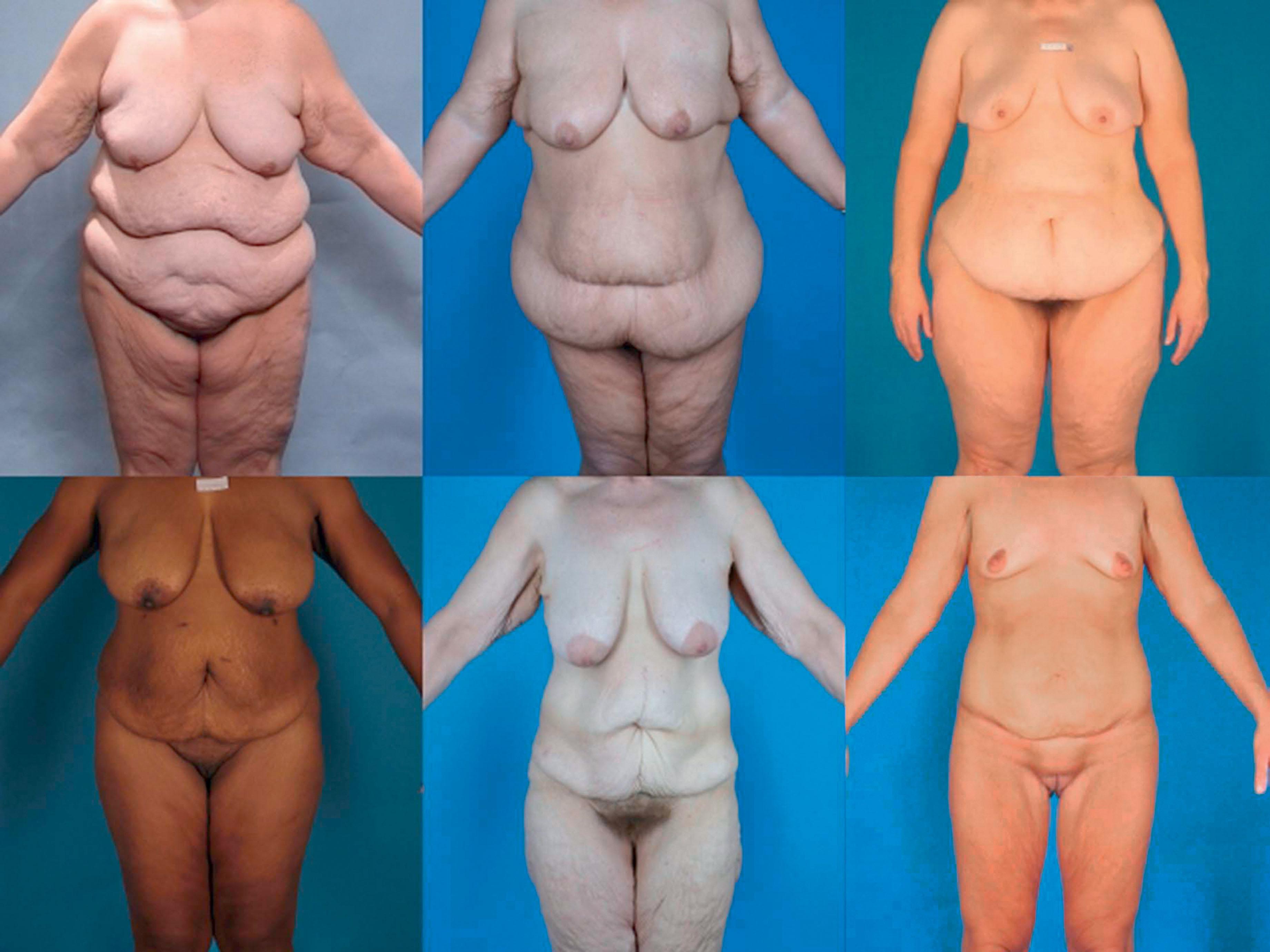 Figure 31.9, Six massive weight loss patients demonstrating the variety in shape and size of their presenting panniculi.