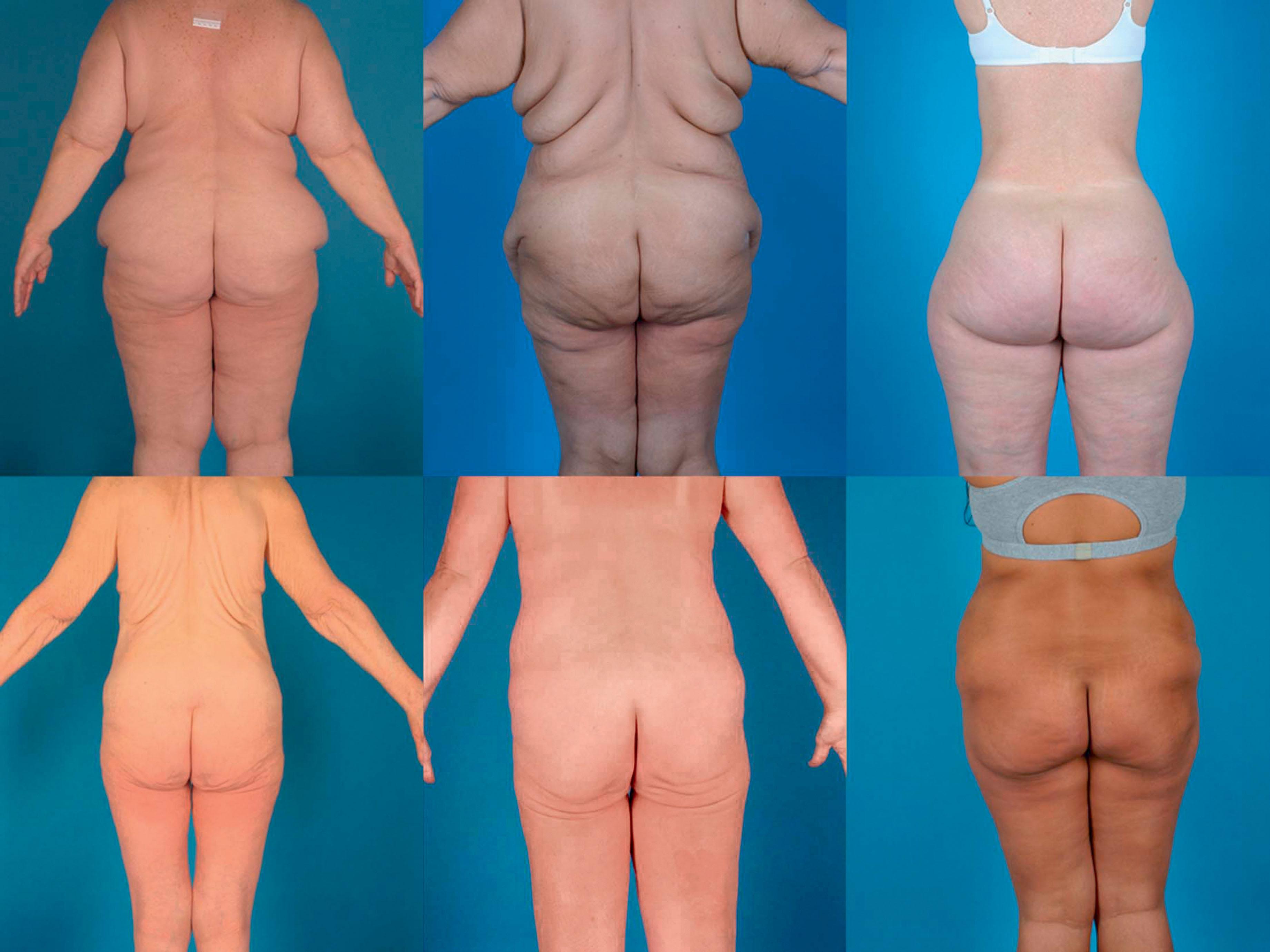 Figure 31.10, The variety in shape and size of the buttocks is demonstrated in these six massive weight loss patients. The accompanying lipodystrophy of the hip region, as well as the descent of the buttocks, often contribute to a lack of buttocks’ definition and demarcation from the lower back.