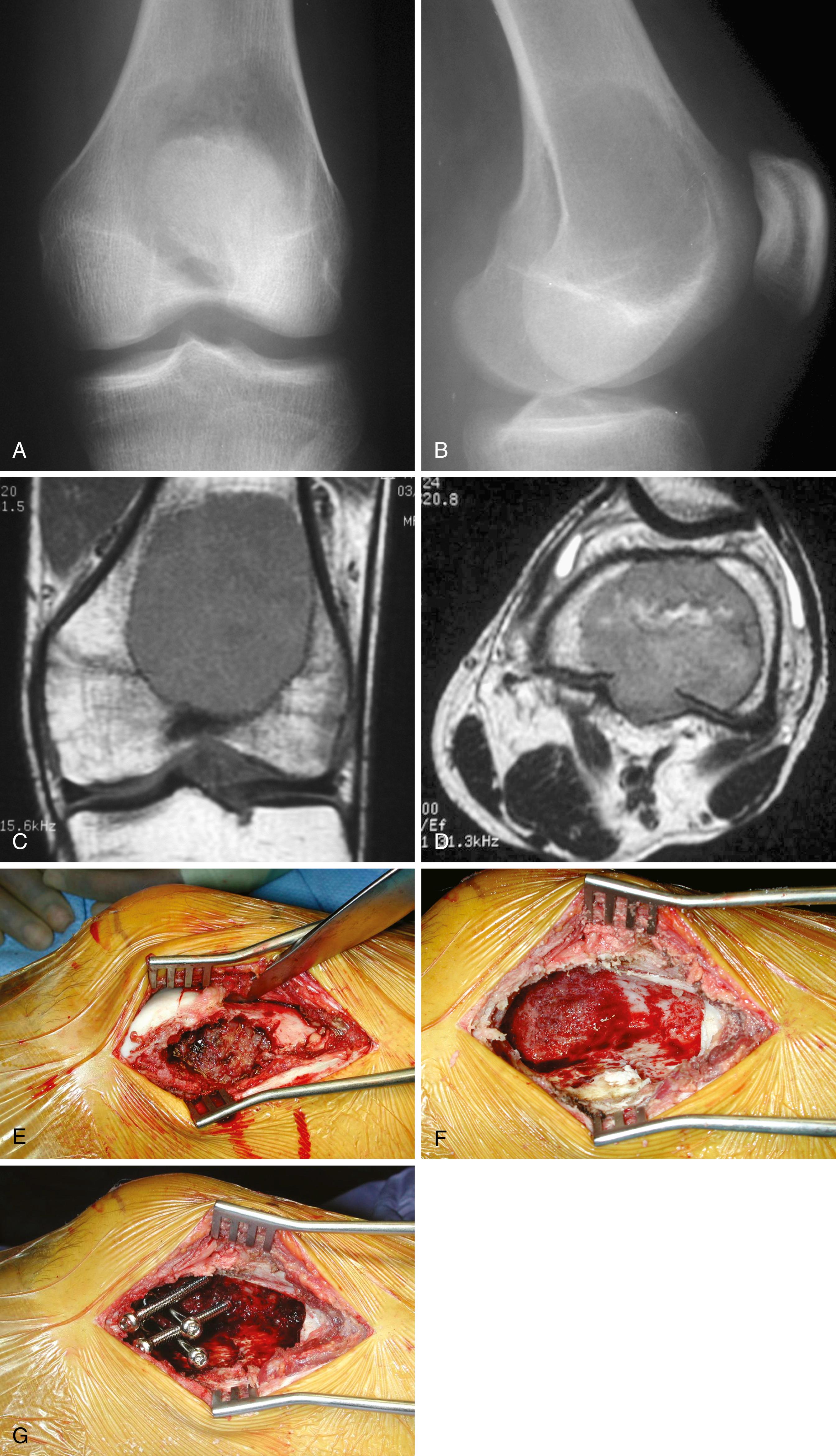 FIGURE 26.1, Giant cell tumor in a 21-year-old man.