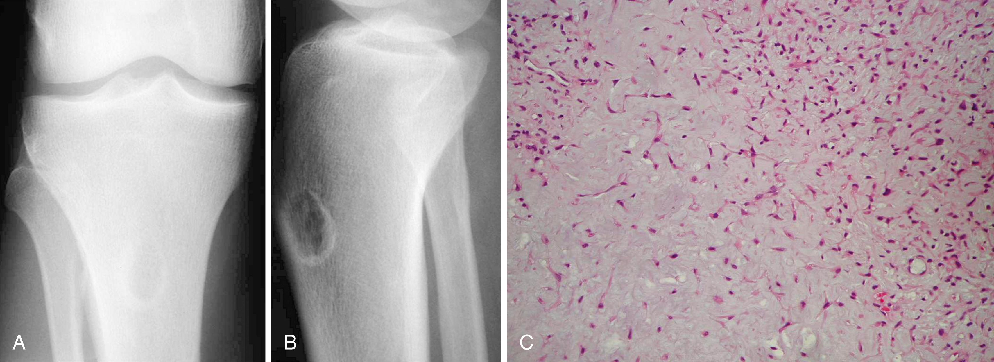 FIGURE 26.11, Chondromyxoid fibroma in a 36-year-old man. Patient had right knee pain for 1 year. A and B, Anteroposterior and lateral radiographs show chondromyxoid fibroma in its most common location, proximal tibial metaphysis. C, Typical microscopic appearance of chondromyxoid fibroma.